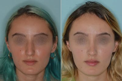 Rhinoplasty before and after, frontal.