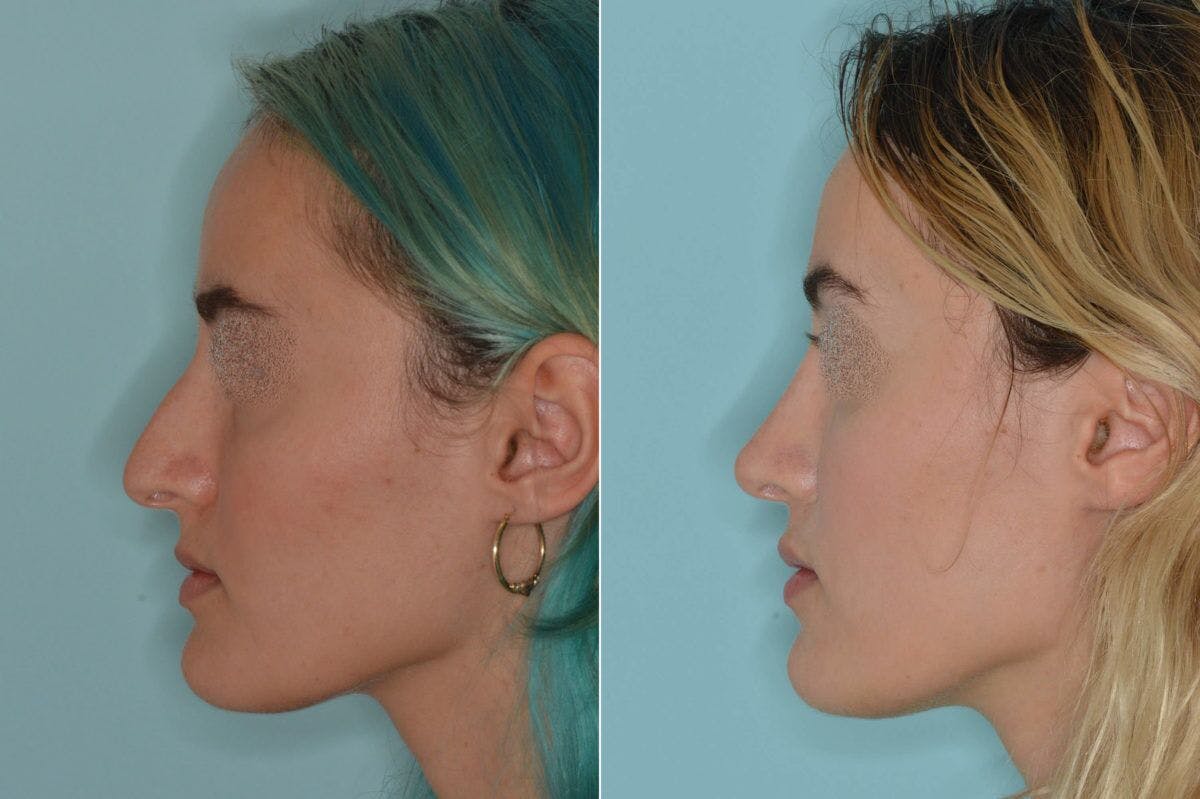 Rhinoplasty before and after, lateral left.