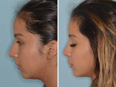 Rhinoplasty before and after, lateral left.