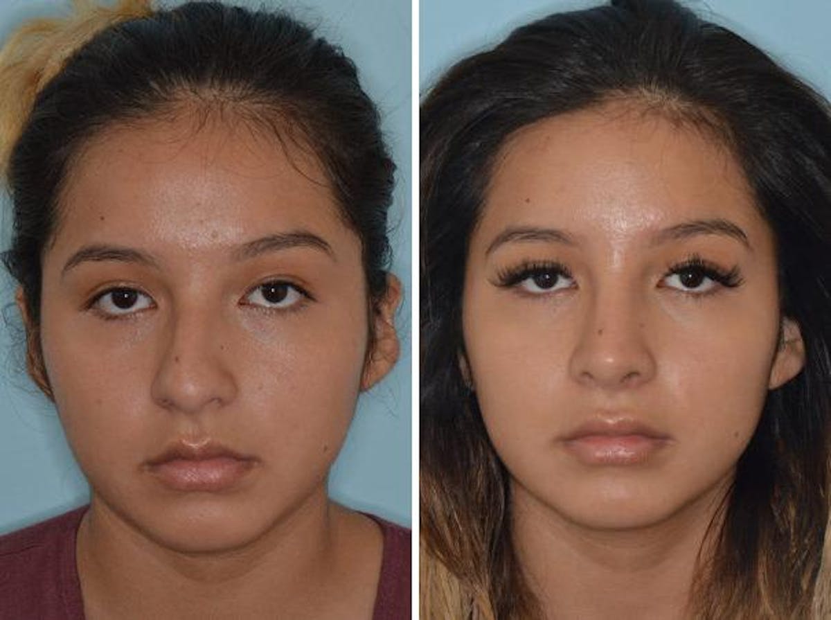 Rhinoplasty before and after, frontal.