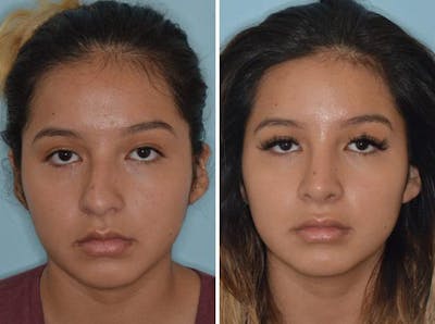 Rhinoplasty before and after, frontal.