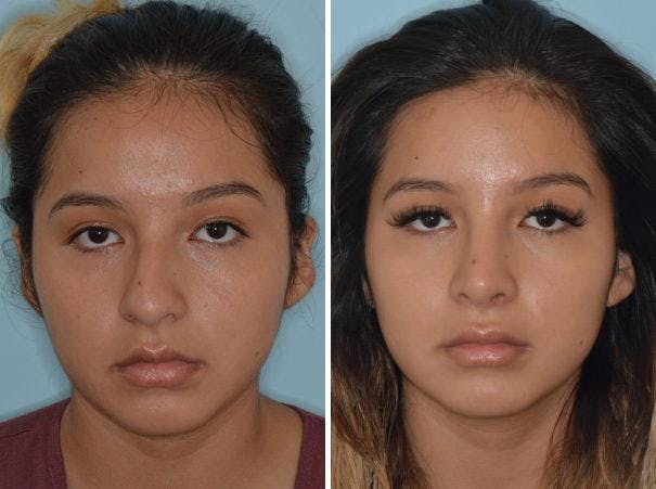 Rhinoplasty before and after, frontal.