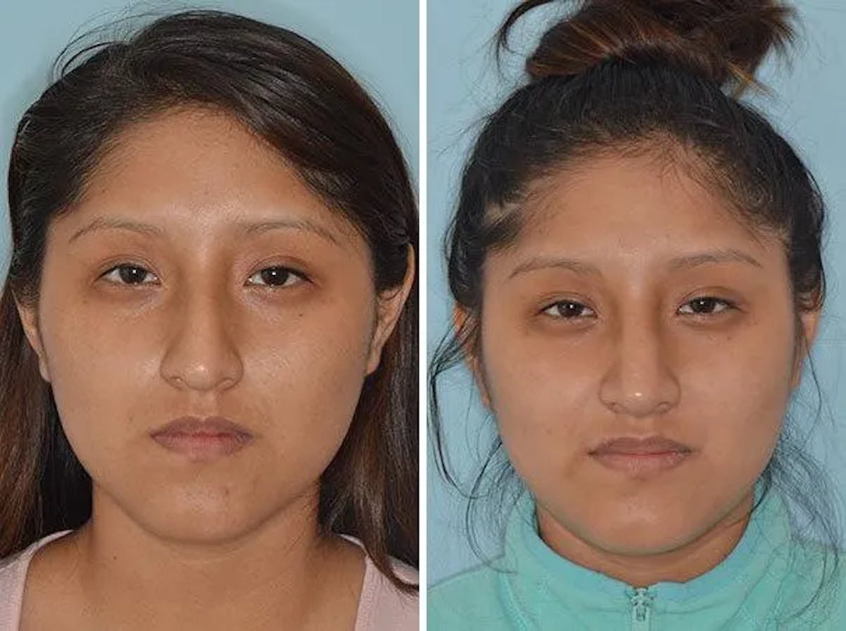 Rhinoplasty before and after, frontal.