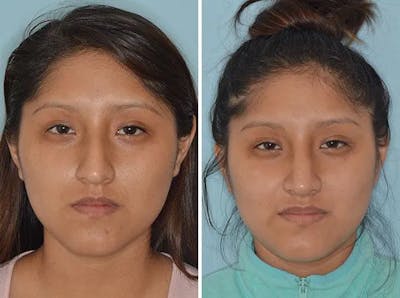 Rhinoplasty before and after, frontal.