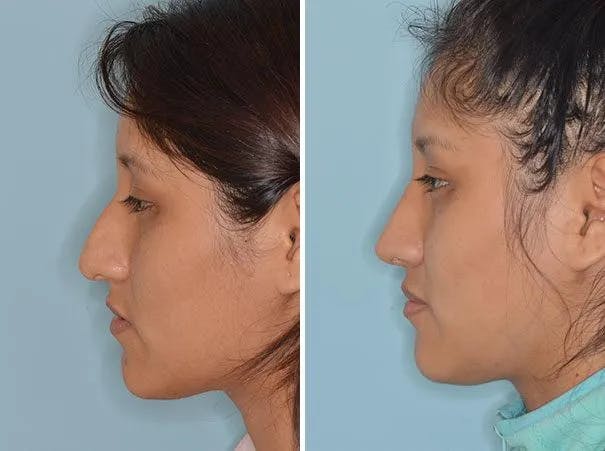 Rhinoplasty before and after, lateral left.