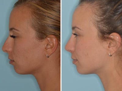 Rhinoplasty before and after, lateral left.