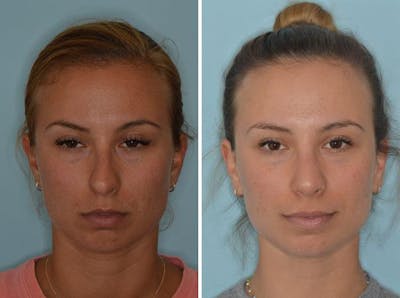 Rhinoplasty before and after, frontal.
