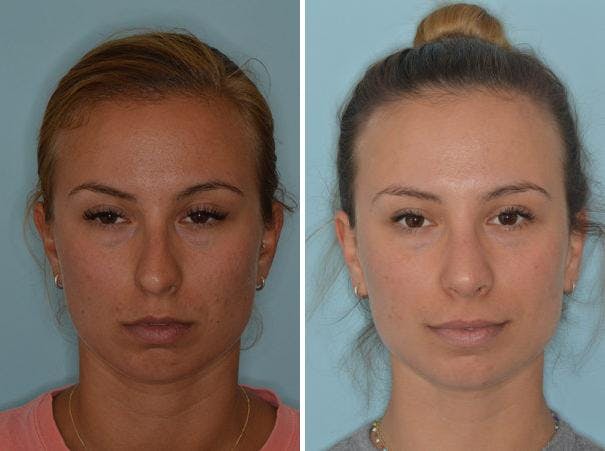 Rhinoplasty before and after, frontal.