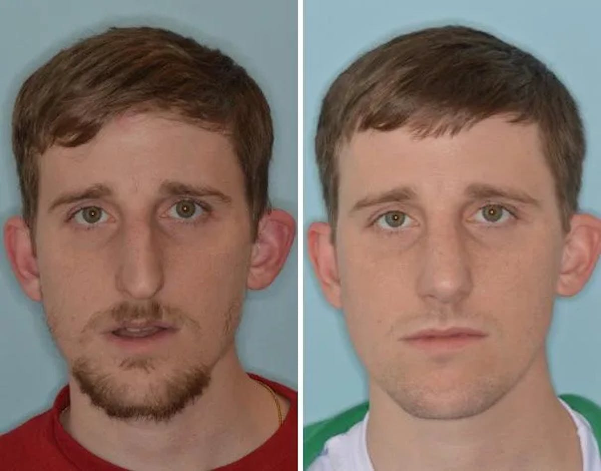 Rhinoplasty before and after, frontal.