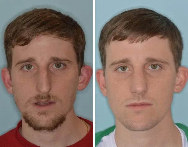 Rhinoplasty before and after, frontal.