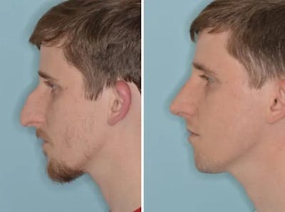 Rhinoplasty before and after, lateral left.