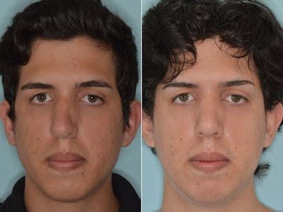 Rhinoplasty before and after, frontal.