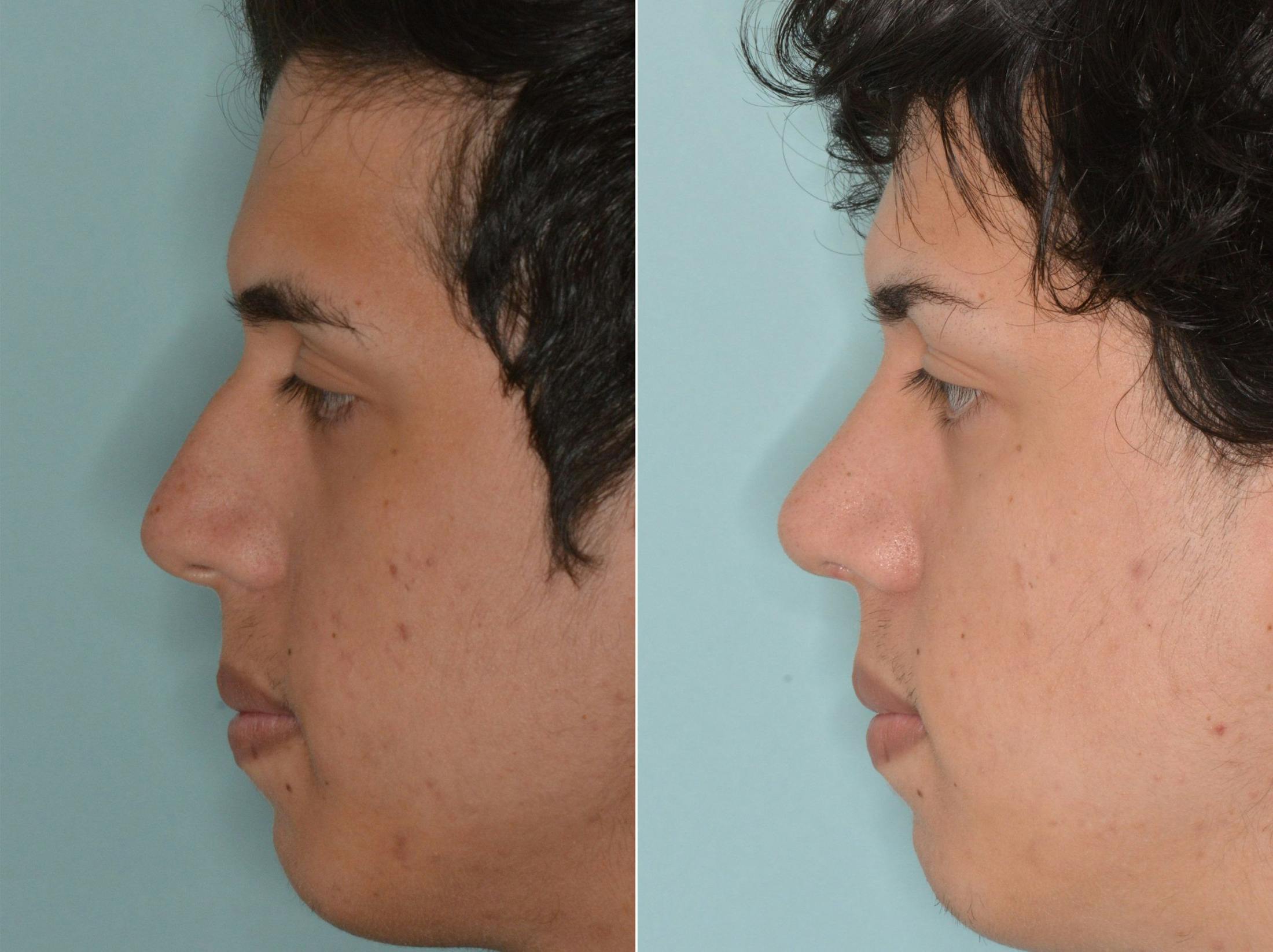 Rhinoplasty before and after, lateral left.