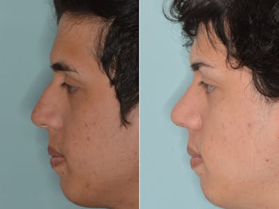 Rhinoplasty before and after, lateral left.