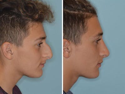 Rhinoplasty before and after, lateral right.