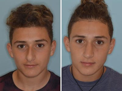 Rhinoplasty before and after, frontal.