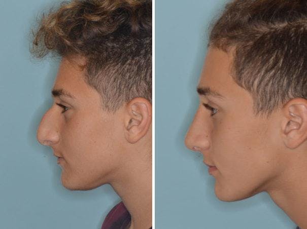 Rhinoplasty before and after, lateral left.