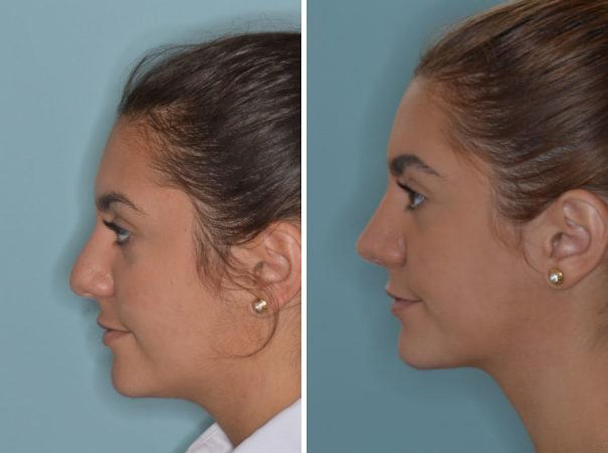 Rhinoplasty before and after, lateral left.