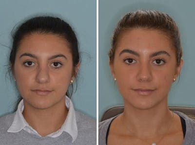 Rhinoplasty before and after, frontal.