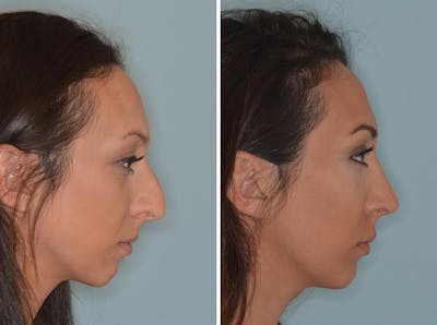 Rhinoplasty before and after, lateral right.