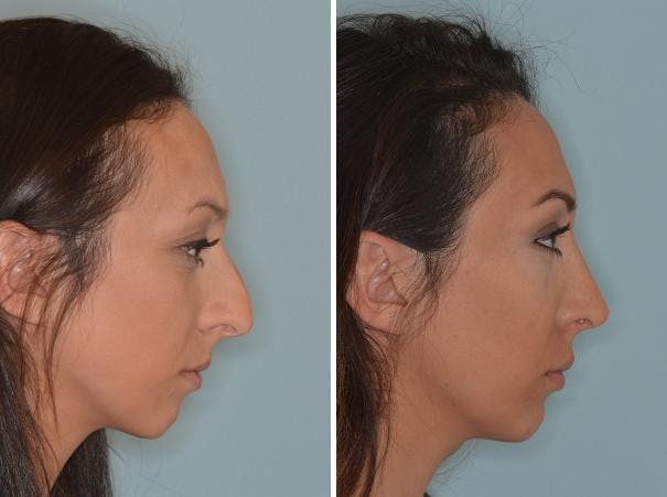 Rhinoplasty before and after, lateral right.