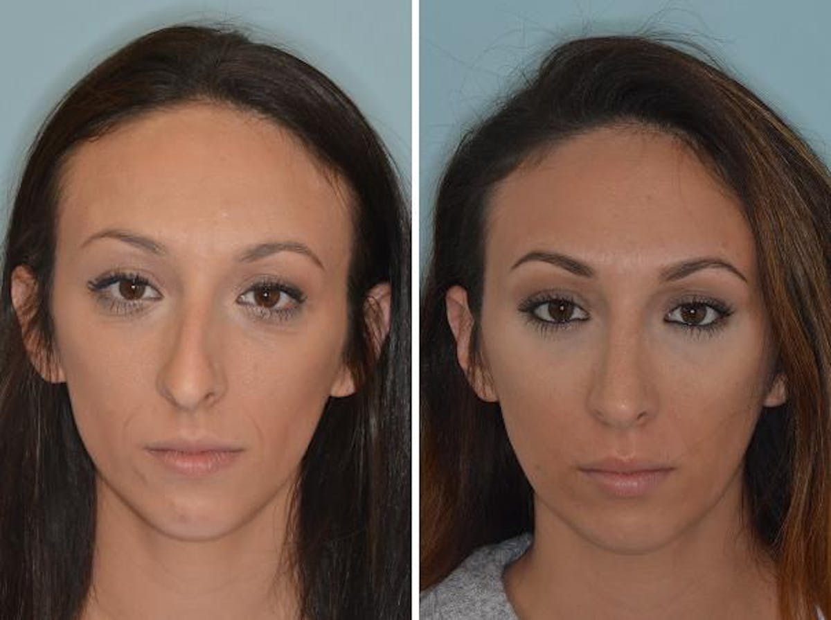 Rhinoplasty before and after, frontal.