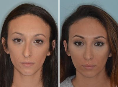 Rhinoplasty before and after, frontal.