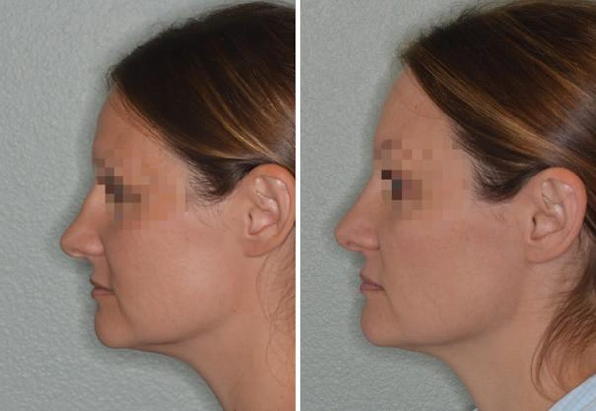 Rhinoplasty before and after, lateral left.