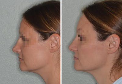 Rhinoplasty before and after, lateral left.