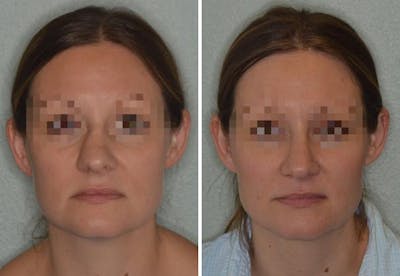 Rhinoplasty before and after, frontal.