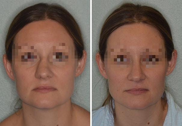 Rhinoplasty before and after, frontal.