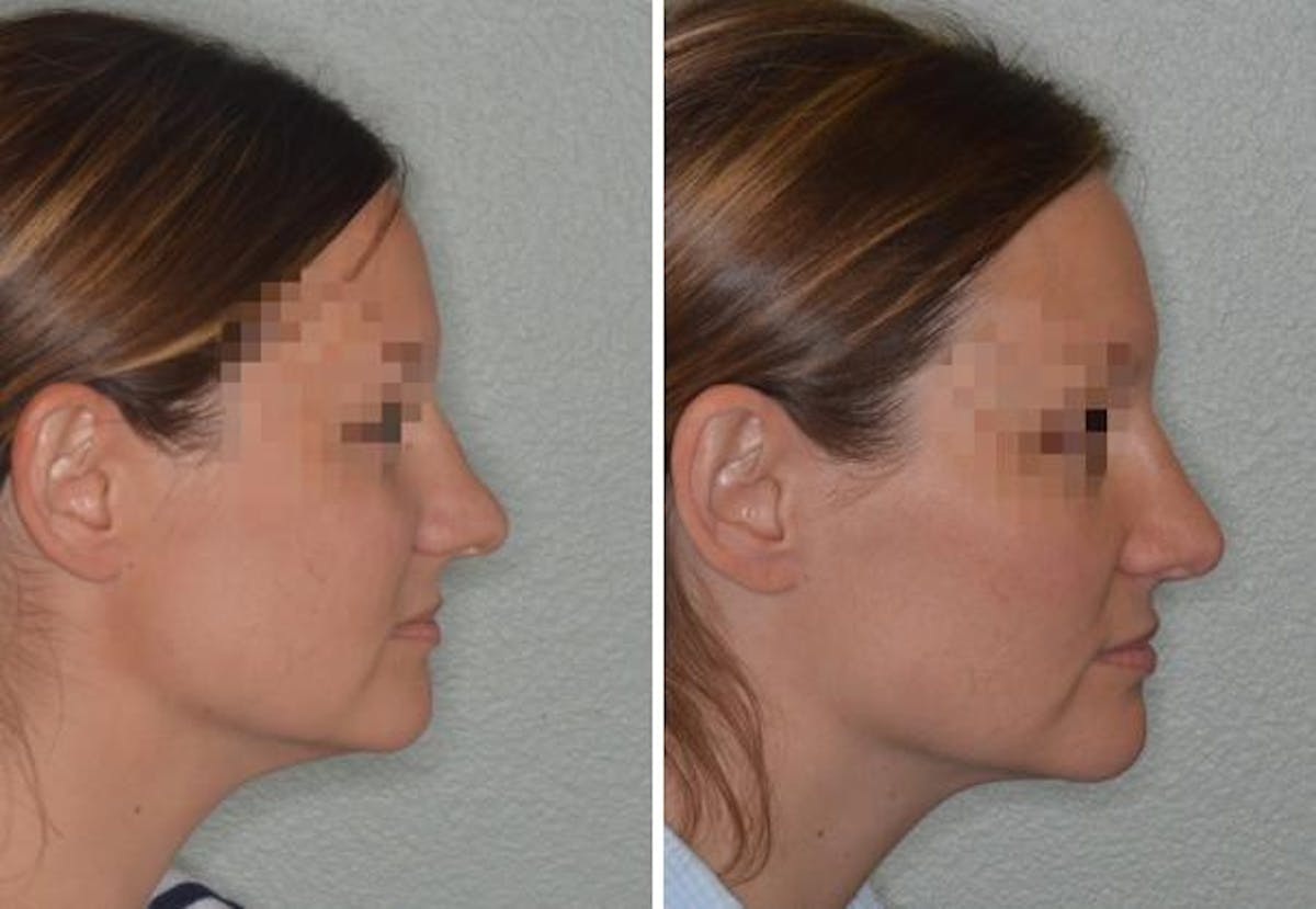 Rhinoplasty before and after, lateral right.