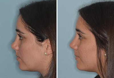 Rhinoplasty before and after, lateral left.