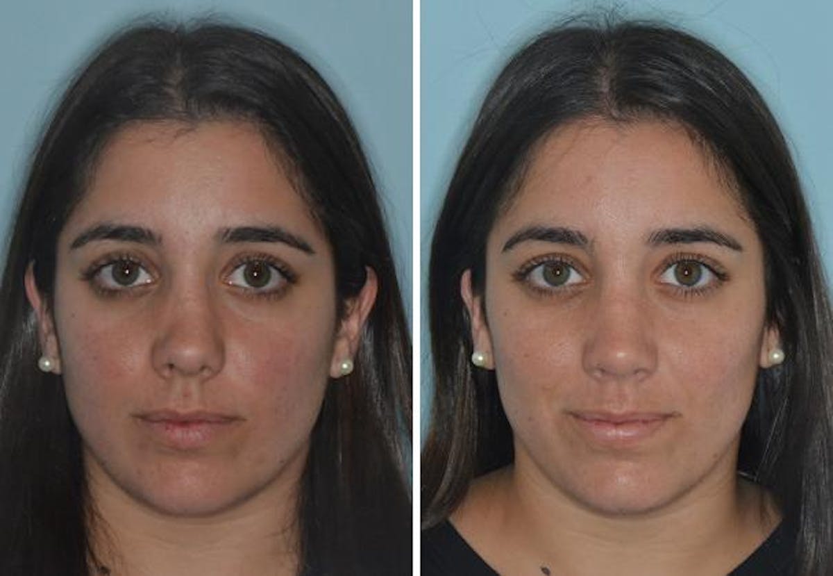 Rhinoplasty before and after, frontal.