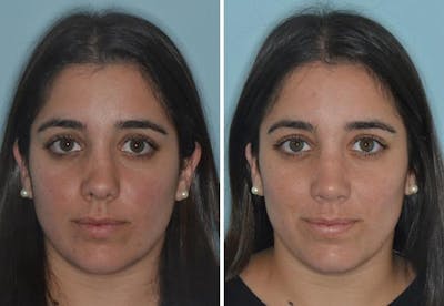 Rhinoplasty before and after, frontal.