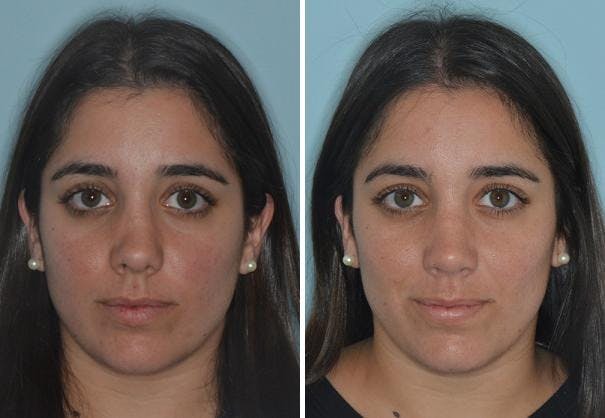 Rhinoplasty before and after, frontal.