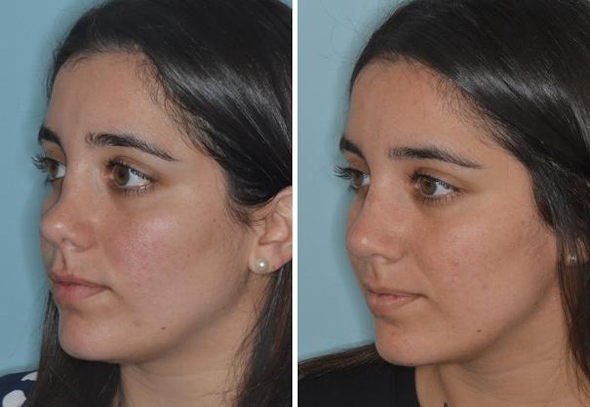 Rhinoplasty before and after, oblique left.