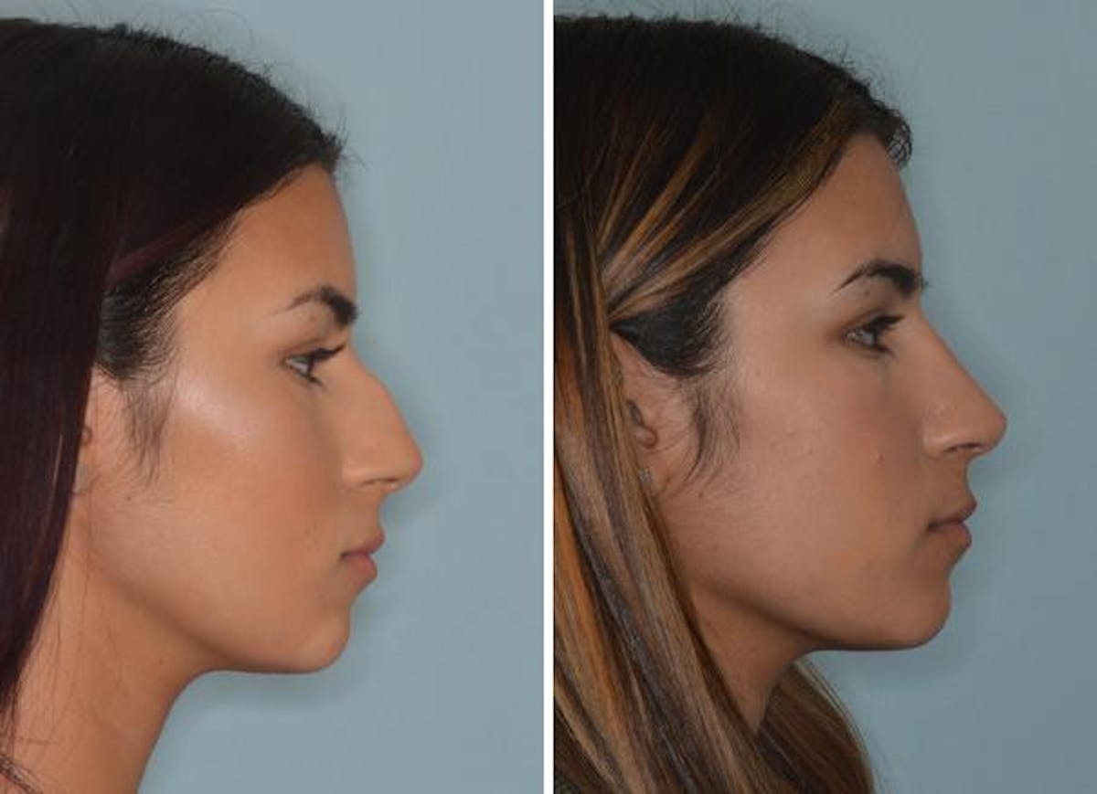Rhinoplasty before and after, lateral right.