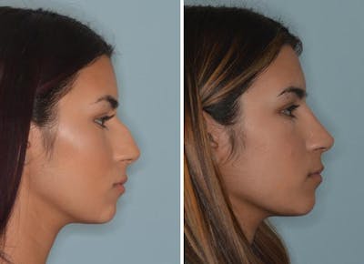 Rhinoplasty before and after, lateral right.