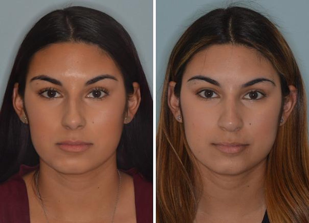 Rhinoplasty before and after, frontal.