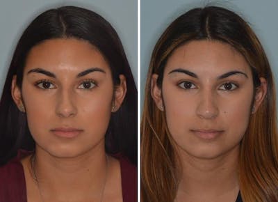 Rhinoplasty before and after, frontal.