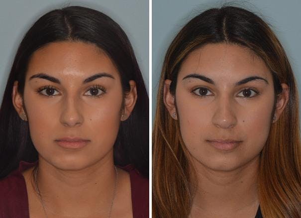 Rhinoplasty before and after, frontal.