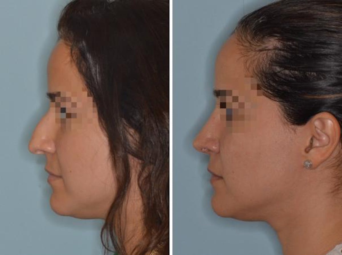 Rhinoplasty before and after, lateral left.
