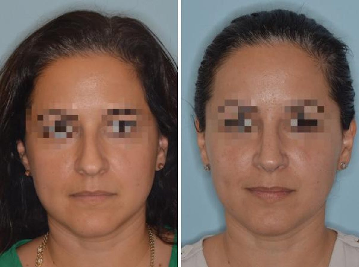 Rhinoplasty before and after, frontal.