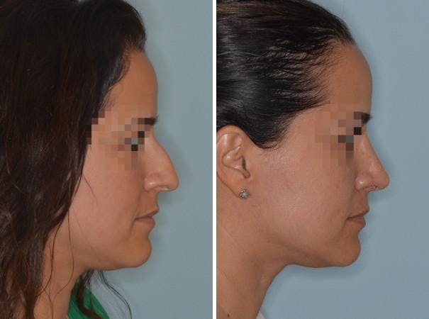 Rhinoplasty before and after, lateral right.