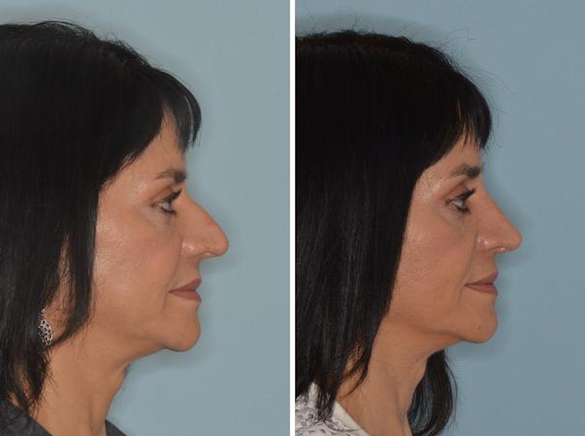 Rhinoplasty before and after, lateral right.