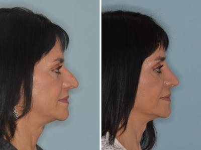 Rhinoplasty before and after, lateral right.