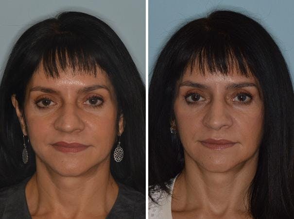 Rhinoplasty before and after, frontal.