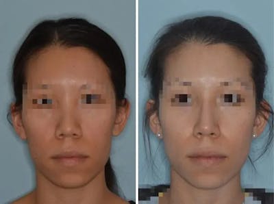 Rhinoplasty before and after, frontal.