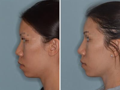 Rhinoplasty before and after, lateral left.
